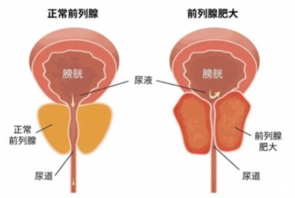 良性前列腺增生，中老年男性“难言之隐”大揭秘