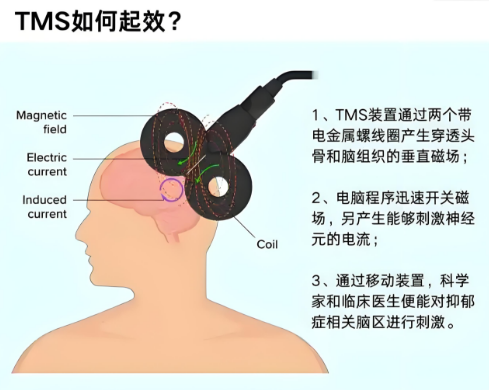 重复经颅磁刺激：无需开刀吃药，用“磁力”唤醒大脑自愈力！