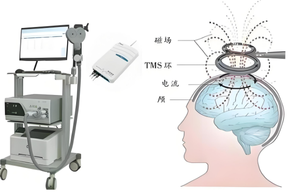 重复经颅磁刺激：无需开刀吃药，用“磁力”唤醒大脑自愈力！