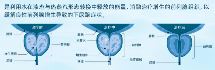 经尿道热蒸汽消融术显效！国德泌尿外科助前列腺增生患者脱困