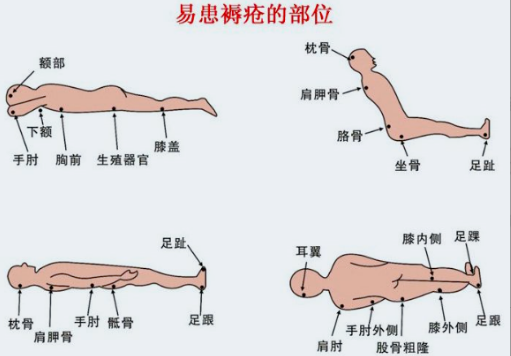 破解压疮误区！邓建沧主任：卧床老人照护需科学评估精准干预