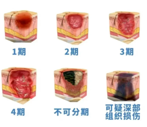 福州国德老年医院外科提醒：压疮可防可治，科学干预助创面稳步恢复