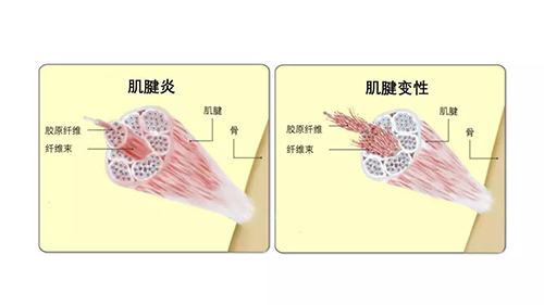 腹股沟联合腱图片